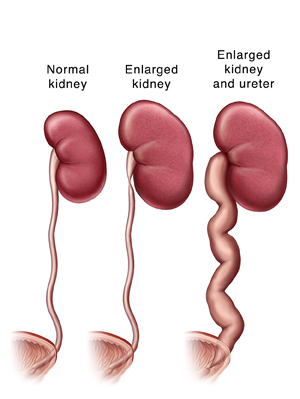 Normal kidney and ureter connected to bladder. Kidney enlarged because of narrowed part in ureter near kidney. Kidney and ureter enlarged because of narrowed part of ureter near bladder.