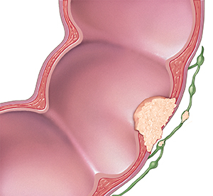 Cross section of colon and lymph nodes showing cancer spreading through wall of colon and to lymph nodes.