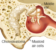 Cross section through mastoid bone and middle ear showing cholesteatoma.