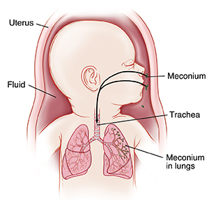 Baby in uterus with head turned to side showing trachea and lungs. Meconium is in fluid inside amniotic fluid. Arrows show meconium going through nose and mouth into lungs. 