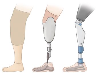 Tres tipos de prótesis de pierna.