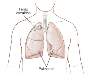 Vista frontal del pecho de un hombre donde pueden verse los pulmones con una zona sombreada que indica el tejido que se extirpará.