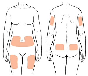 Contorno de una figura humana donde pueden verse los lugares donde aplicarse las inyecciones en el frente y la parte posterior del torso, frente de los muslos y la parte posterior de los brazos.