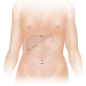 Contorno de una mujer donde pueden verse el tracto digestivo inferior y el hígado. Las líneas indican las incisiones para una cirugía laparoscópica de vesícula.