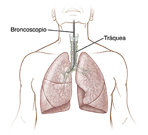Vista frontal de la tráquea, los bronquios y los pulmones con un broncoscopio flexible insertado en la tráquea.