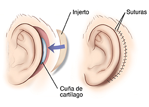Dos imágenes en las que se muestra una vista lateral de la reconstrucción de un pabellón auditivo. En la primera imagen se observa una cuña de cartílago insertada detrás de la oreja. En la segunda imagen se observa un injerto de piel para cubrir el lugar de la inserción.