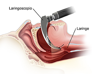 Vista lateral de la cabeza donde se observa cómo se coloca el laringoscopio por la boca y la faringe.