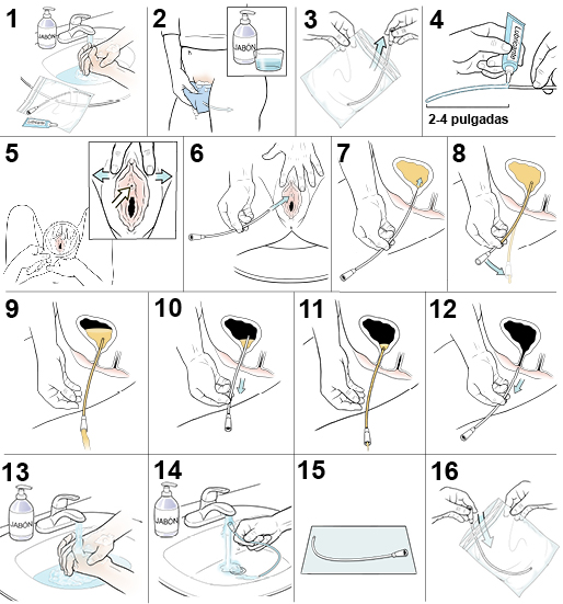 16 pasos para saber cómo se inserta un catéter urinario femenino.