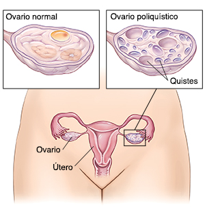 Vista frontal del aparato reproductor femenino. En los recuadros se observa un ovario normal y uno poliquístico.