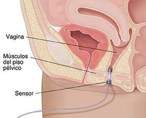 Primer plano de corte transversal de pelvis femenina donde puede verse un sensor en la vagina.