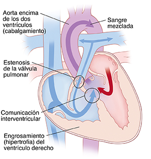 Corte transversal de vista frontal de un corazón que muestra tetralogía de Fallot: la aorta encima de ambos ventrículos (cabalgamiento), estenosis valvular pulmonar, comunicación interventricular (CIV) y ventrículo derecho engrosado (hipertrofia). Las flechas muestran que la sangre circula de la izquierda y derecha del corazón a través de la CIV, se mezcla y se bombea hacia afuera de la aorta. Algo de sangre circula desde el lado derecho del corazón a la arteria pulmonar.