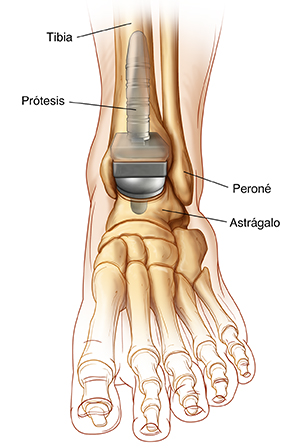 Vista frontal de los huesos del tobillo y del pie donde se observa una artroplastia de tobillo.
