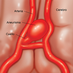 Primer plano de un cerebro donde se observa una arteria con un aneurisma sacular.