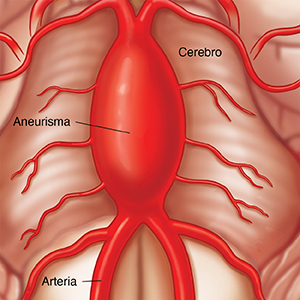 Primer plano de un cerebro donde se observa una arteria con un aneurisma fusiforme.