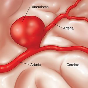 Primer plano de un cerebro donde se observa un aneurisma gigante que afecta dos arterias.