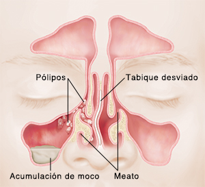 Vista frontal de los senos paranasales donde pueden verse los pólipos, la acumulación de moco, y el tabique desviado.