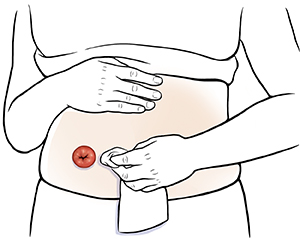 Abdomen de una mujer donde pueden verse manos limpiando la zona alrededor del estoma.