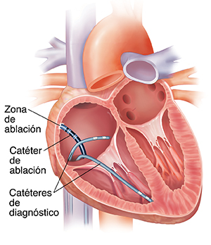 Corte transversal del corazón en el que pueden verse catéteres insertados en la aurícula derecha. Un catéter está destruyendo tejido de la pared de la aurícula.