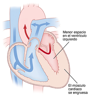 Corte transversal de un corazón con cardiomiopatía hipertrófica.