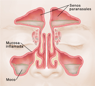 Vista frontal de los senos paranasales donde pueden verse las membranas inflamadas y enrojecidas, y mucosidad.
