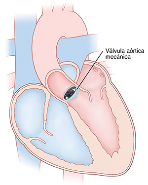 Corte transversal de vista frontal de un corazón en donde se ve una válvula aórtica mecánica colocada.
