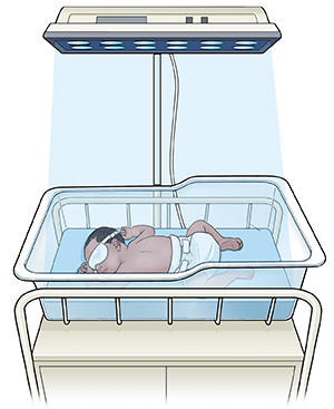 Bebé en incubadora con los ojos cubiertos y una lámpara de fototerapia sobre la incubadora.