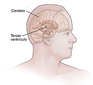 Vista lateral de la cabeza de un hombre donde se observa el tercer ventrículo del cerebro.