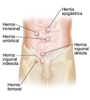 Vista frontal de abdomen masculino donde pueden verse diferentes tipos de hernias.