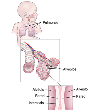 Vista frontal del cuerpo de un niño pequeño en donde se observa el aparato respiratorio. El recuadro muestra un bronquiolo y los alvéolos. El segundo recuadro muestra un primer plano extremo del tejido intersticial entre dos alveolos.