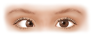 Vista frontal de los ojos de un niño donde se observan un ojo mirando al frente y otro mirando hacia la nariz.