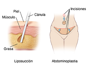Dos imágenes: a la izquierda se muestran las capas de piel con la cánula extirpando grasa durante la liposucción; a la derecha se muestra un abdomen femenino con incisiones para abdominoplastia.