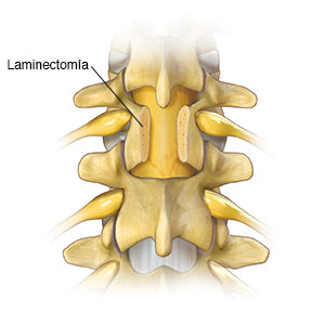 Vista posterior de las vértebras de la parte baja de la espalda que muestra la lámina de una vértebra totalmente removida.