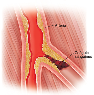 Vaso sanguíneo con placa en las paredes y un coágulo sanguíneo que obstruye el canal.