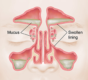 Front view of sinuses showing red, swollen lining and mucus.