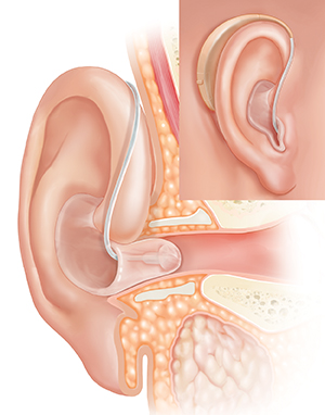 Ear showing hearing aid in ear canal with part of hearing aid behind the ear.