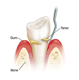 Side view of tooth in bone with instrument doing scaling.