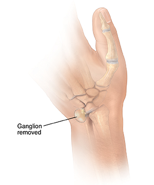 Back view of hand showing dotted line around ganglion cyst on wrist.